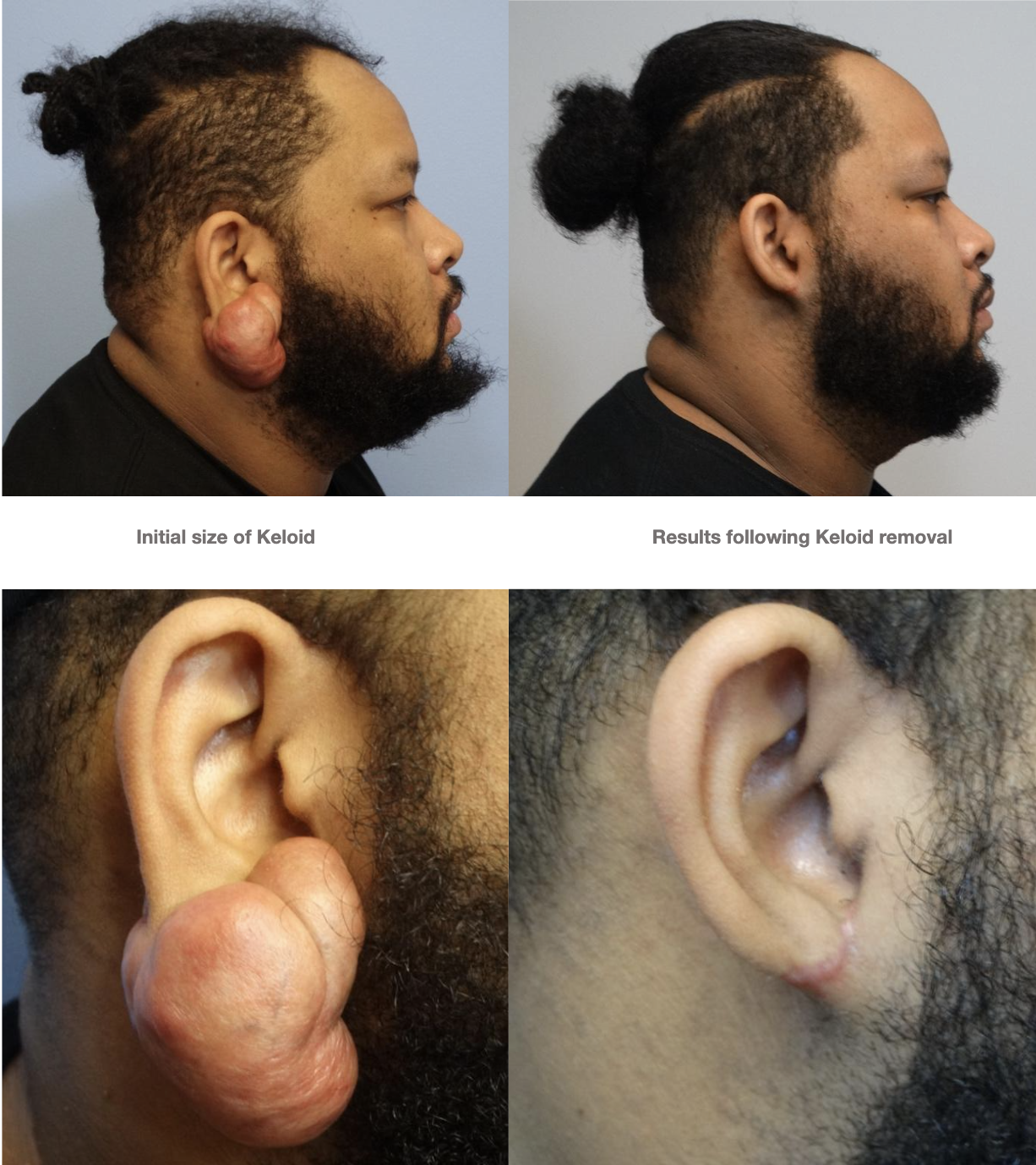 Ear Keloid Compression Clip Single Clip on Earring for Post-op