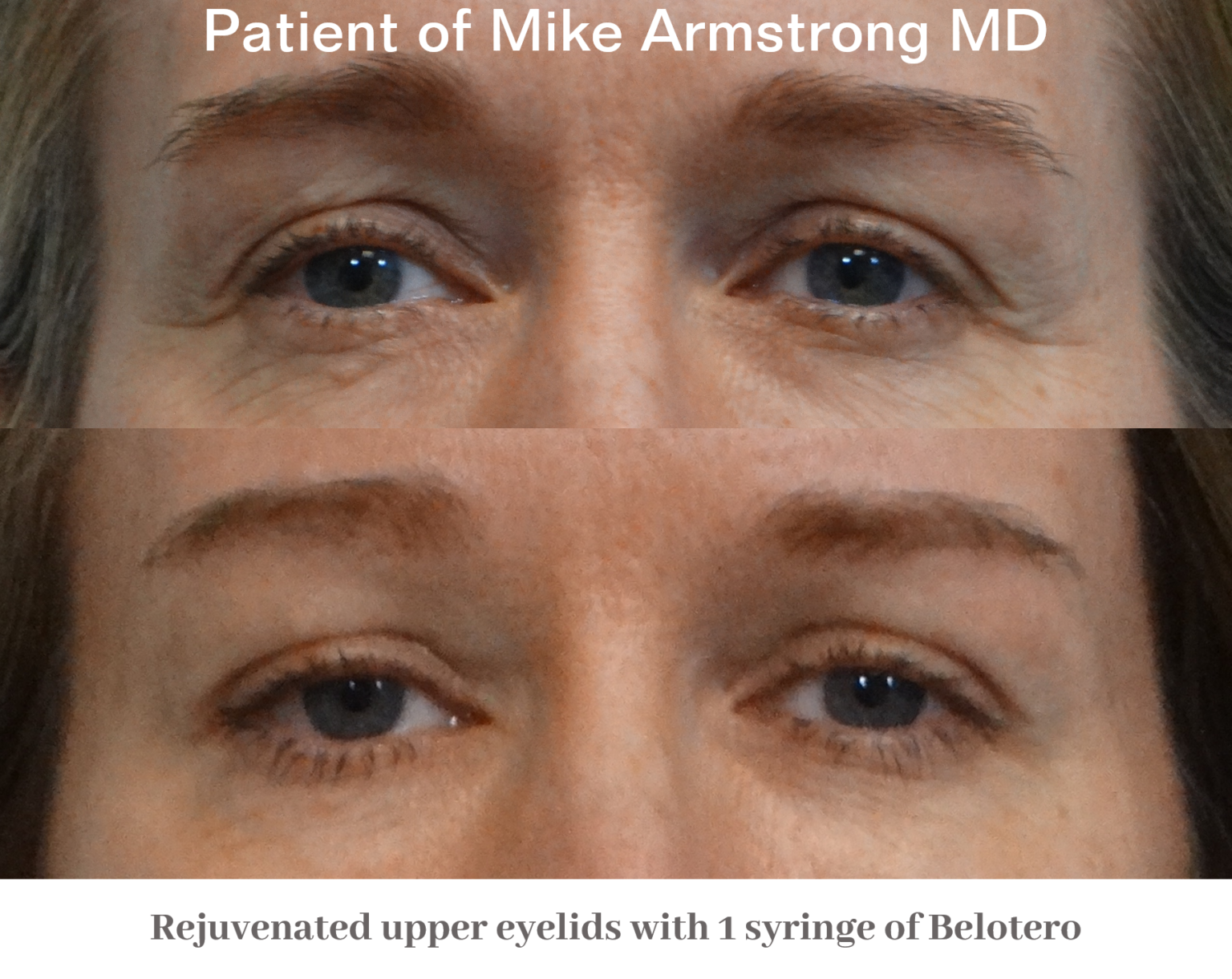 Juvéderm, Belotero, & Revanesse Richmond ENT