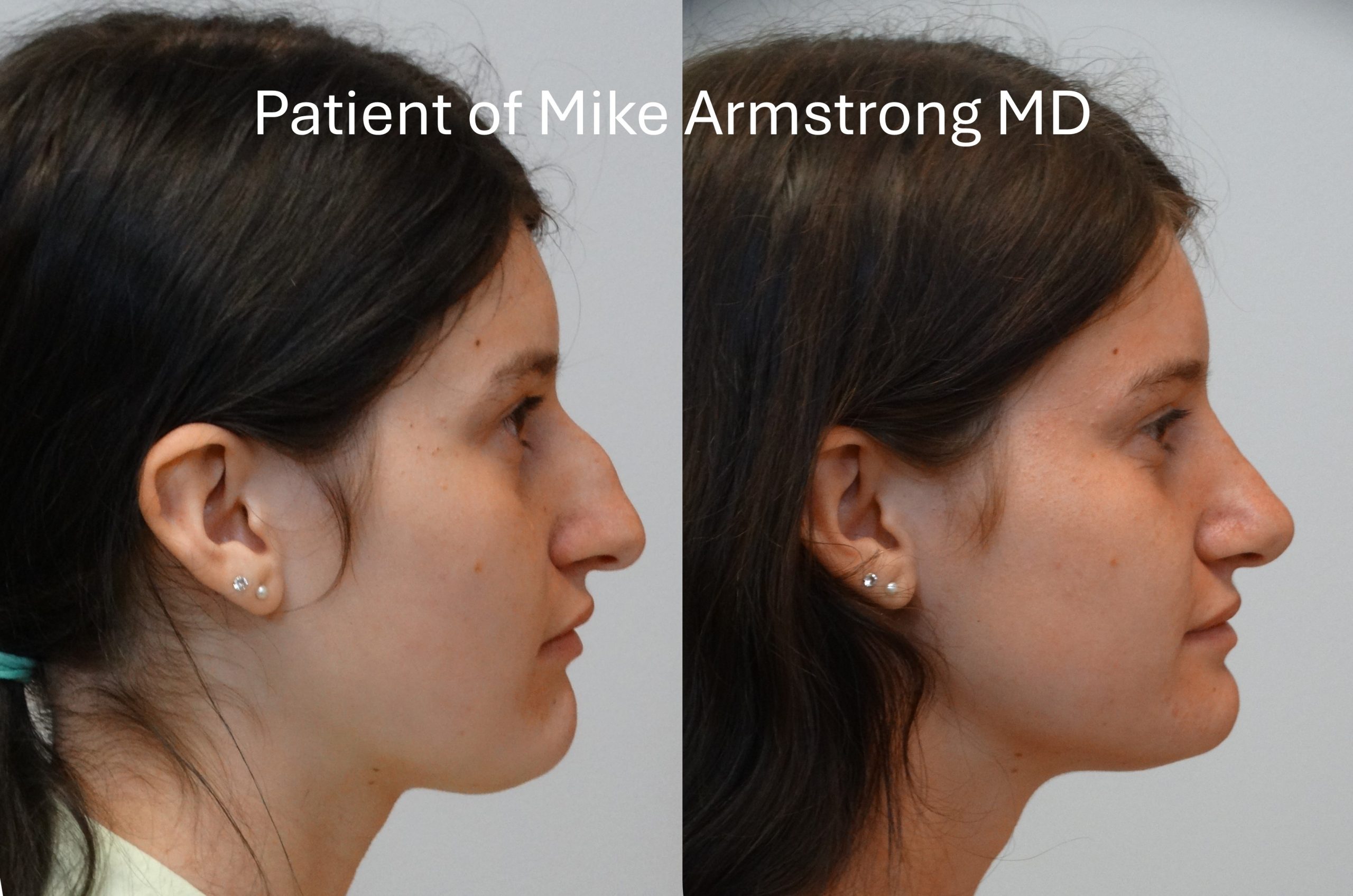 Before and after rhinoplasty